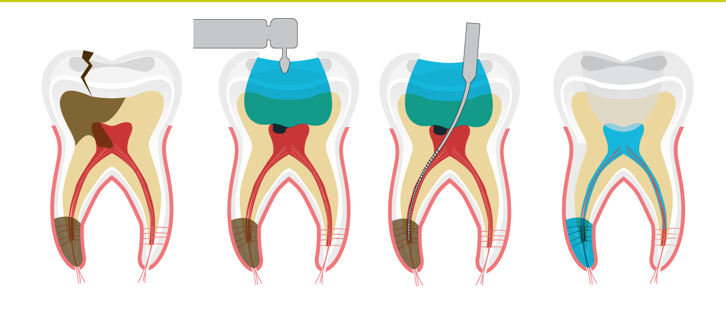 Endodoncia Dental