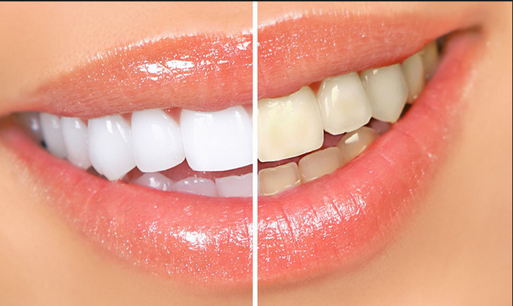 Blanqueamiento Dental