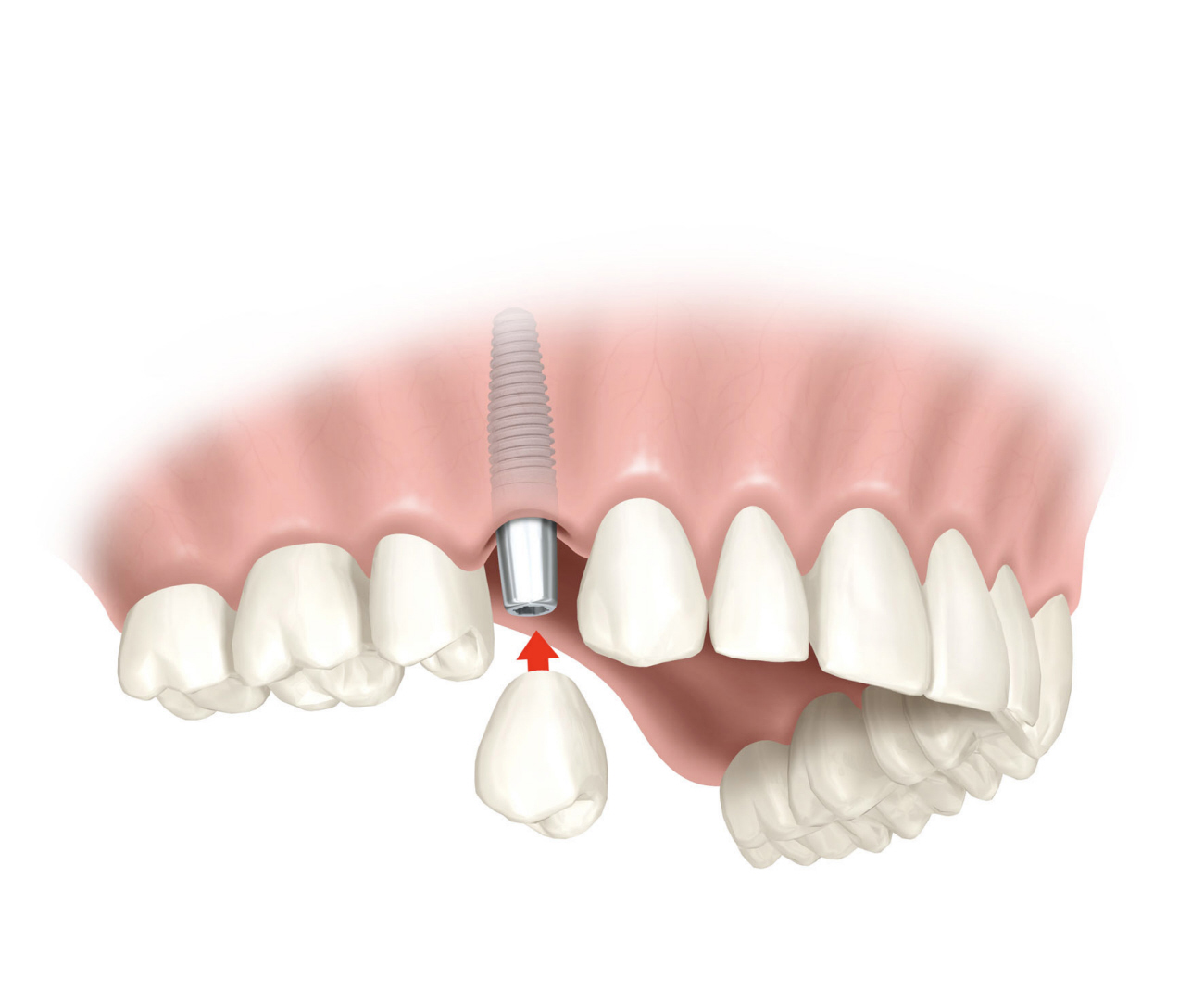 Implante Dental