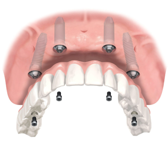 Prótesis Dental